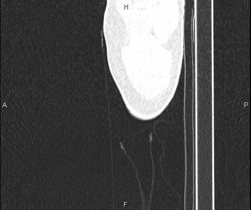 Bilateral pulmonary AVM (Radiopaedia 83134-97505 Sagittal lung window 117).jpg