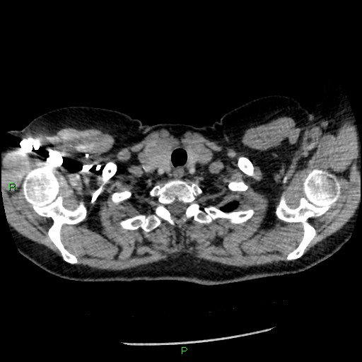 Bilateral pulmonary emboli (Radiopaedia 32700-33669 Axial C+ CTPA 6).jpg