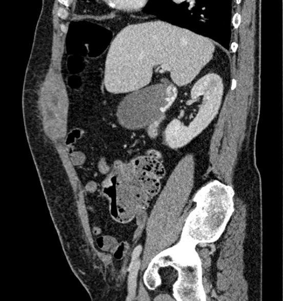 File:Bilateral rectus sheath hematomas (Radiopaedia 50778-56252 B 28).jpg