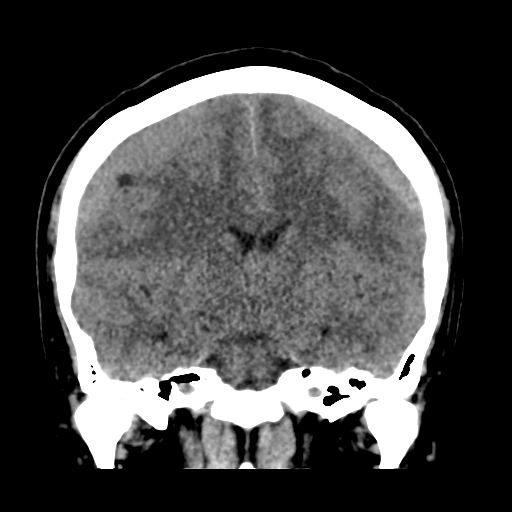 Bilateral subacute subdural hematoma (Radiopaedia 69240-79018 Coronal non-contrast 29).jpg
