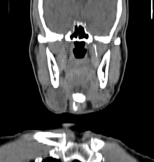 Bilateral submandibular sialolithiasis with sialadenitis (Radiopaedia 70721-80881 Coronal non-contrast 29).jpg