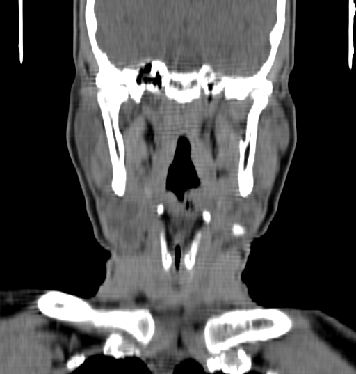 Bilateral submandibular sialolithiasis with sialadenitis (Radiopaedia 70721-80881 Coronal non-contrast 54).jpg