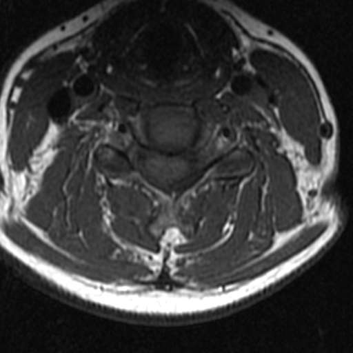 File:Bilateral tortuous vertebral arteries (Radiopaedia 19070-19039 Axial T2 9).jpg