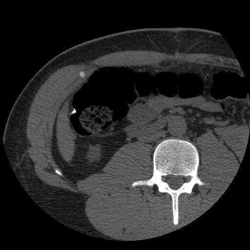 Bile leak from liver traumatic laceration (Radiopaedia 63463-72077 Axial Biliscopin 80).jpg
