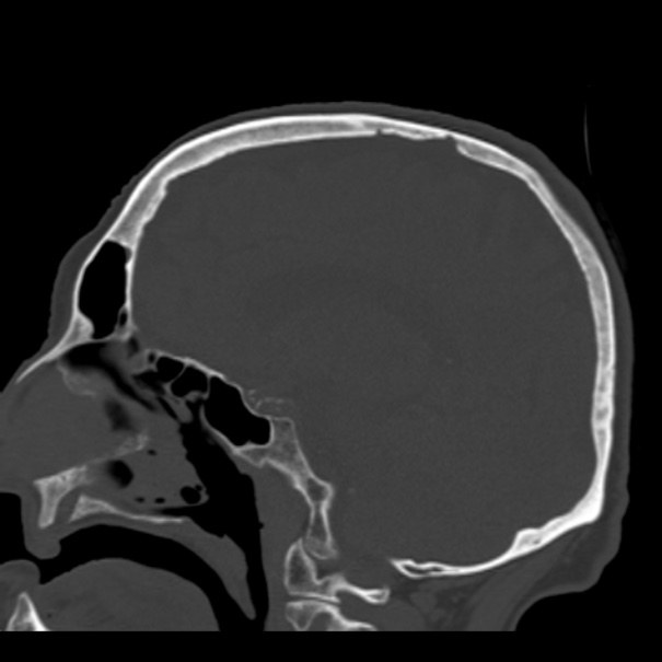 Biparietal osteodystrophy (Radiopaedia 46109-50463 Sagittal bone window 61).jpg
