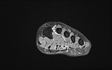Bipartite hallux sesamoid diastasis (Radiopaedia 77133-89109 Coronal T2 fat sat 13).jpg