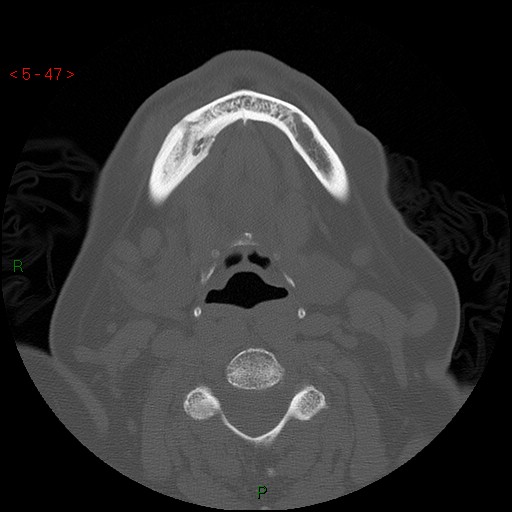 Bisphosphonate-related osteonecrosis of the jaw (Radiopaedia 54147-60329 Axial bone window 41).jpg