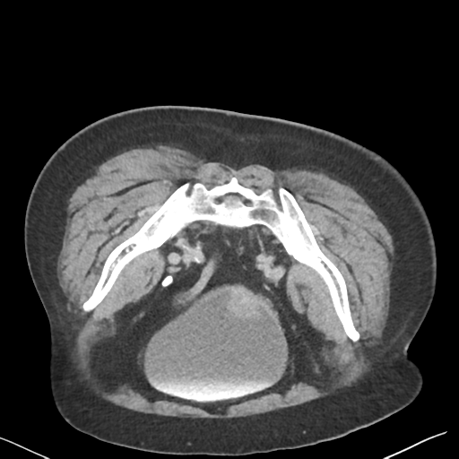 File:Bladder papillary urothelial carcinoma (Radiopaedia 48119-52951 Axial C+ delayed 46).png