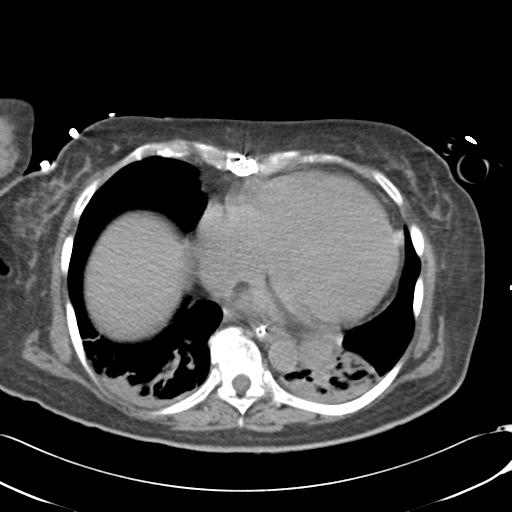 File:Bladder rupture post renal biopsy (Radiopaedia 30863-31572 Axial non-contrast 6).jpg