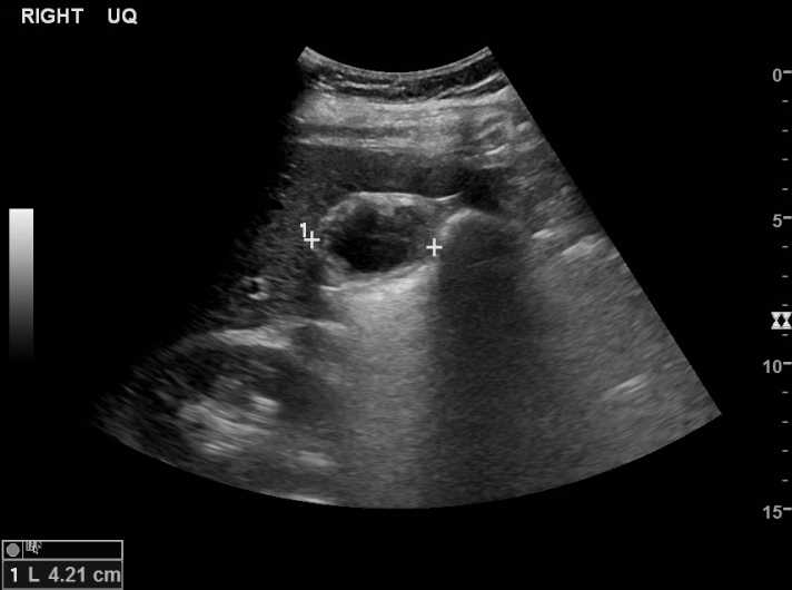 File:Bleeding duodenal ulcer and adenomyomatosis of gallbladder (Radiopaedia 61834-69873 A 7).jpg