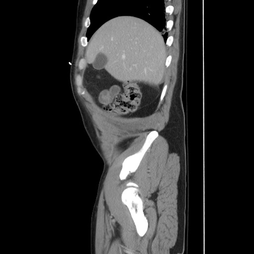 Blunt abdominal trauma with solid organ and musculoskelatal injury with active extravasation (Radiopaedia 68364-77895 C 36).jpg