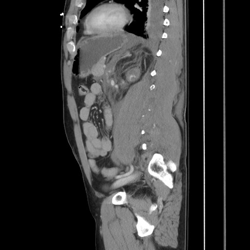 Blunt abdominal trauma with solid organ and musculoskelatal injury with active extravasation (Radiopaedia 68364-77895 C 93).jpg