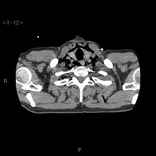 Boerhaave syndrome (Radiopaedia 27683-27897 oral contrast 12).jpg