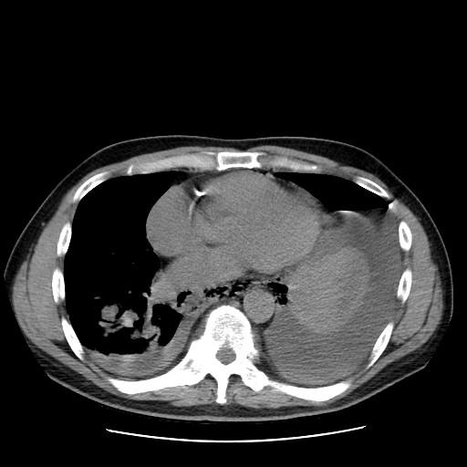 Boerhaave syndrome (Radiopaedia 59796-67310 Axial liver window 41).jpg