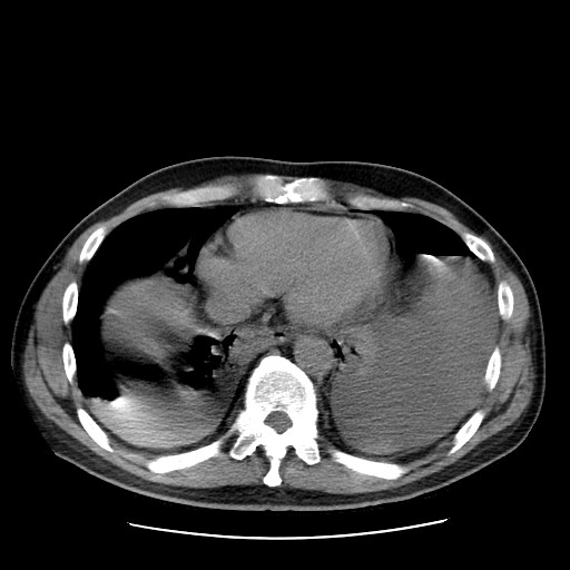 Boerhaave syndrome (Radiopaedia 59796-67310 Axial liver window 47).jpg