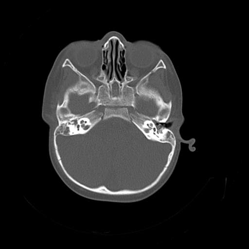File:Bony atresia of the right external auditory canal (Radiopaedia 27916-28156 Axial bone window 6).jpg