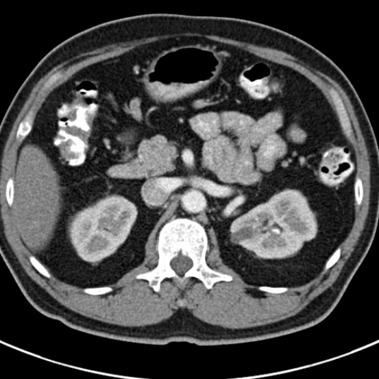 File:Bosniak cyst - type IV (Radiopaedia 23525-23627 renal cortical phase 16).jpg