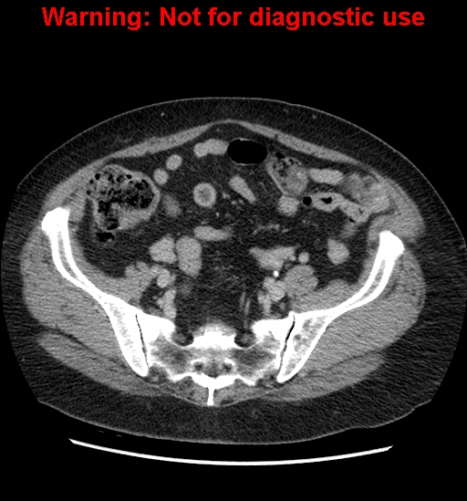 File:Bosniak renal cyst - type II (Radiopaedia 23404-23468 F 49).jpg
