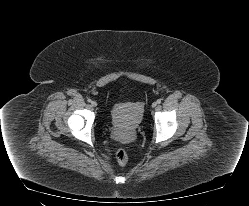 Bowel and splenic infarcts in acute lymphocytic leukemia (Radiopaedia 61055-68913 A 114).jpg