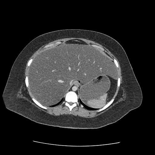 Bowel and splenic infarcts in acute lymphocytic leukemia (Radiopaedia 61055-68915 A 29).jpg