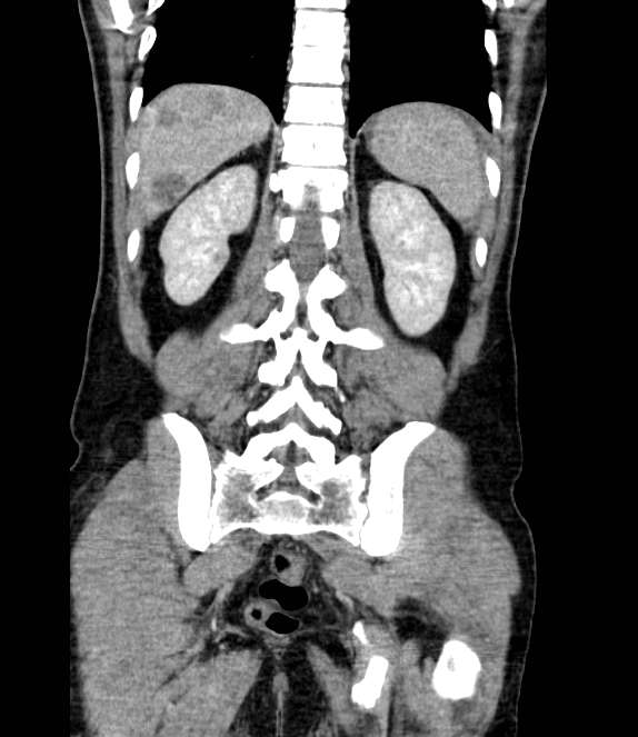 Bowel obstruction from colon carcinoma (Radiopaedia 22995-23028 C 58).jpg