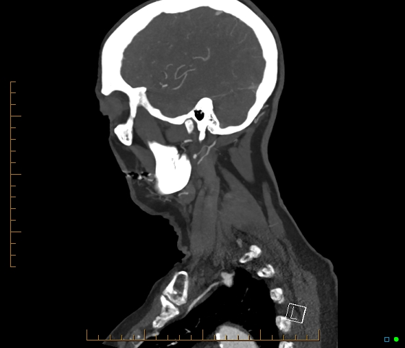 Brachiocephalic trunk stenosis (Radiopaedia 87242-103519 C 15).jpg