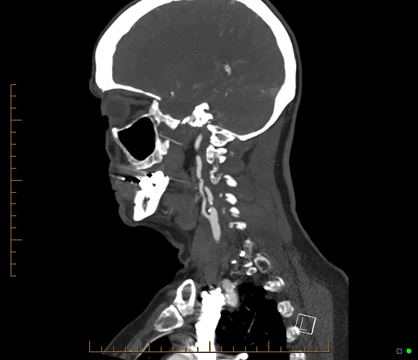 Brachiocephalic trunk stenosis (Radiopaedia 87242-103519 C 45).jpg
