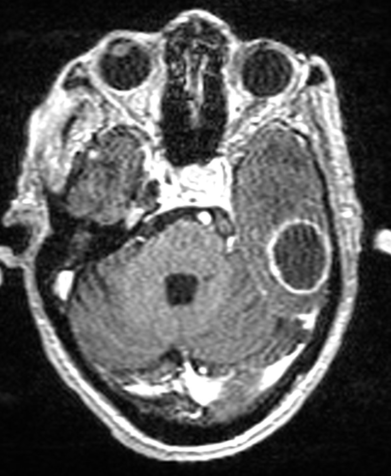 Brain abscess with dual rim sign (Radiopaedia 87566-103938 Axial T1 C+ 52).jpg