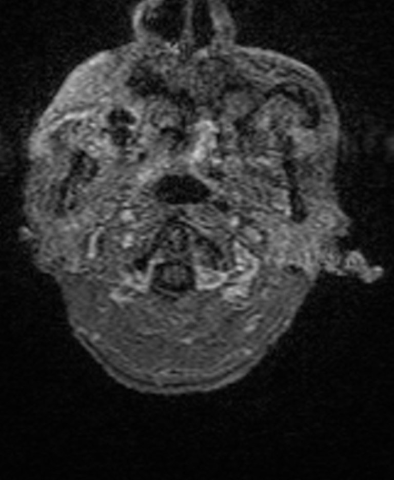 Brain abscess with dual rim sign (Radiopaedia 87566-103938 Axial T1 C+ 9).jpg