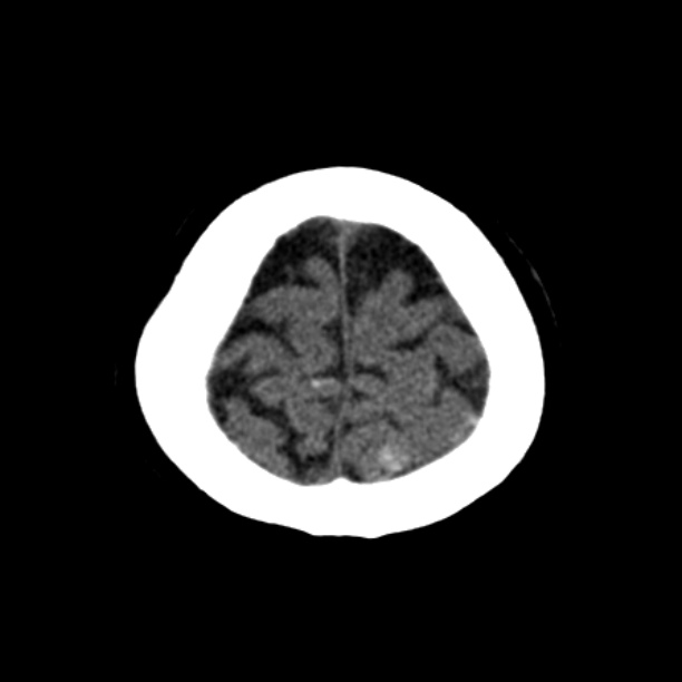 Brain cortical laminar necrosis (Radiopaedia 25822-25971 Axial non-contrast 43).jpg
