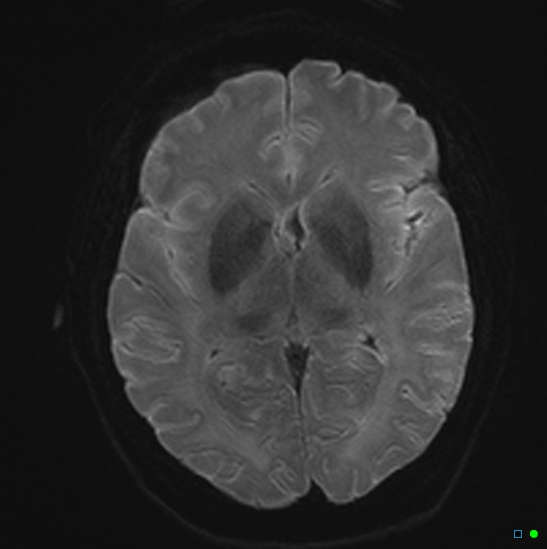 File:Brain death on MRI and CT angiography (Radiopaedia 42560-45689 Axial DWI 13).jpg
