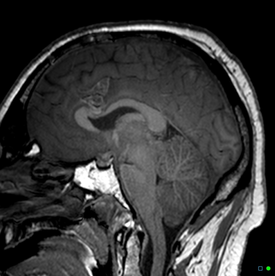 Brain death on MRI and CT angiography (Radiopaedia 42560-45689 Sagittal T1 24).jpg
