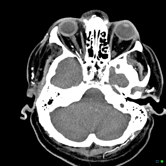 Brain death on MRI and CT angiography (Radiopaedia 42560-45841 B 40).jpg