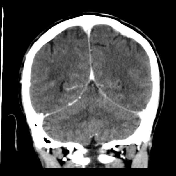 Brain metastases from lung cancer (Radiopaedia 24480-24781 Coronal C+ delayed 46).jpg