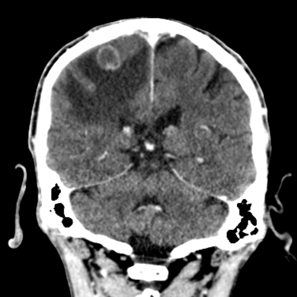 Brain metastases from lung cancer (Radiopaedia 27849-28092 Coronal C+ delayed 43).jpg
