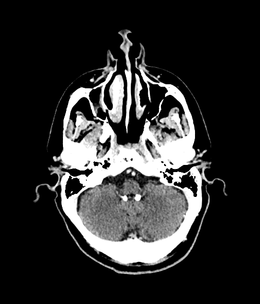 Brain metastasis (large cystic mass) (Radiopaedia 47497-52106 Axial C+ 17).png
