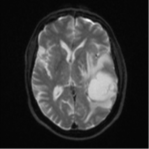 Brain metastasis (large cystic mass) (Radiopaedia 47497-52107 Axial DWI 14).png