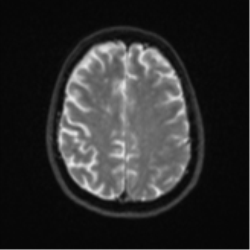 Brain metastasis (large cystic mass) (Radiopaedia 47497-52107 Axial DWI 20).png