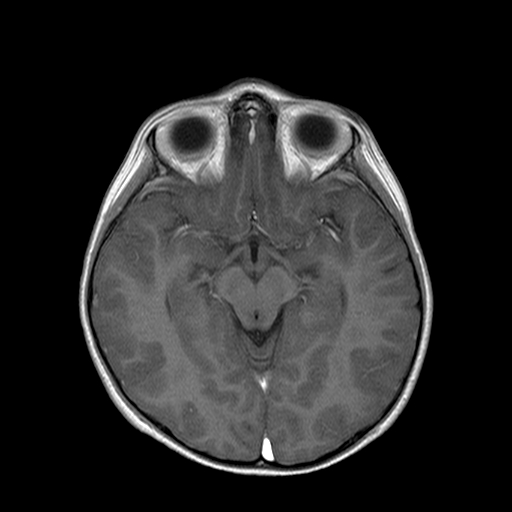 File:Brainstem ganglioglioma (Radiopaedia 10763-11224 Axial T1 C+ 4).jpg