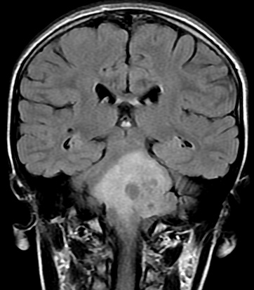 File:Brainstem glioma (Radiopaedia 9444-10124 Coronal FLAIR 1).jpg