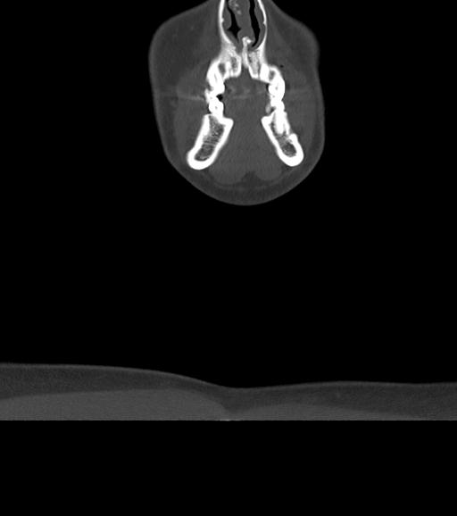 Branchial cleft cyst (Radiopaedia 31167-31875 Coronal bone window 12).jpg
