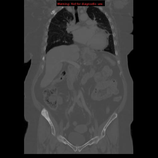 File:Breast cancer metastasis (Radiopaedia 10001-10554 B 30).jpg