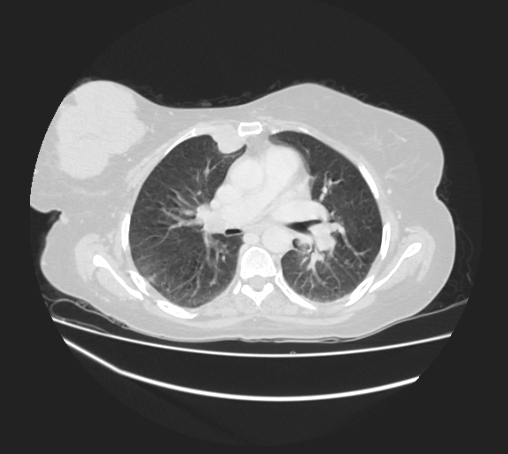 Breast metastases from facial malignant melanoma (Radiopaedia 60316-67975 Axial lung window 49).jpg