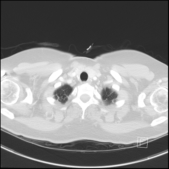 File:Breast metastases from renal cell cancer (Radiopaedia 79220-92225 Axial lung window 4).jpg