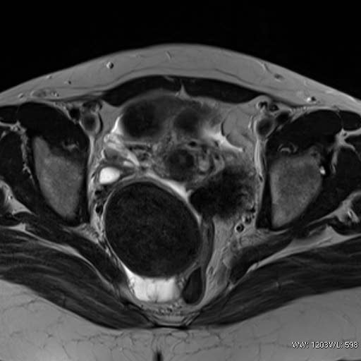 File:Broad ligament fibroid (Radiopaedia 49135-54241 Axial T2 19).jpg