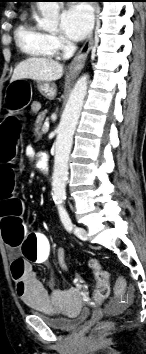Broad ligament hernia (Radiopaedia 84802-100276 C 35).jpg