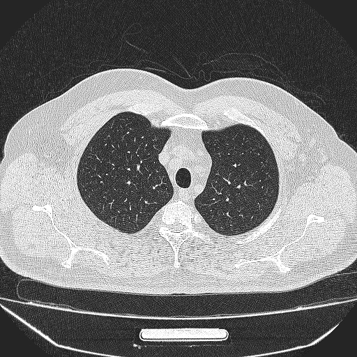 File:Bronchial atresia (Radiopaedia 58271-65417 Axial lung window 7).jpg