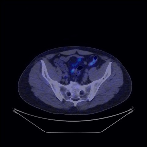 Bronchial carcinoid tumor (Radiopaedia 67377-76765 68Ga-DOTATATE PET-CT 66).jpg