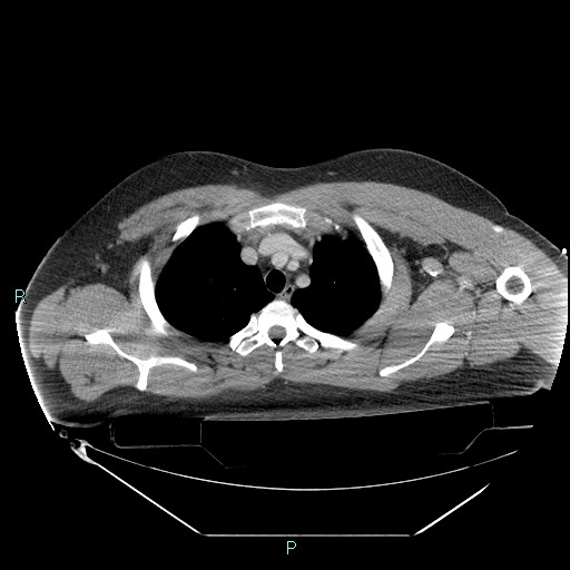 File:Bronchial carcinoid tumor (Radiopaedia 78272-90870 C 31).jpg