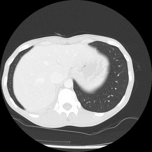 Bronchial carcinoid tumor causing right lower lobe collapse (Radiopaedia 83495-98594 Axial lung window 49).jpg